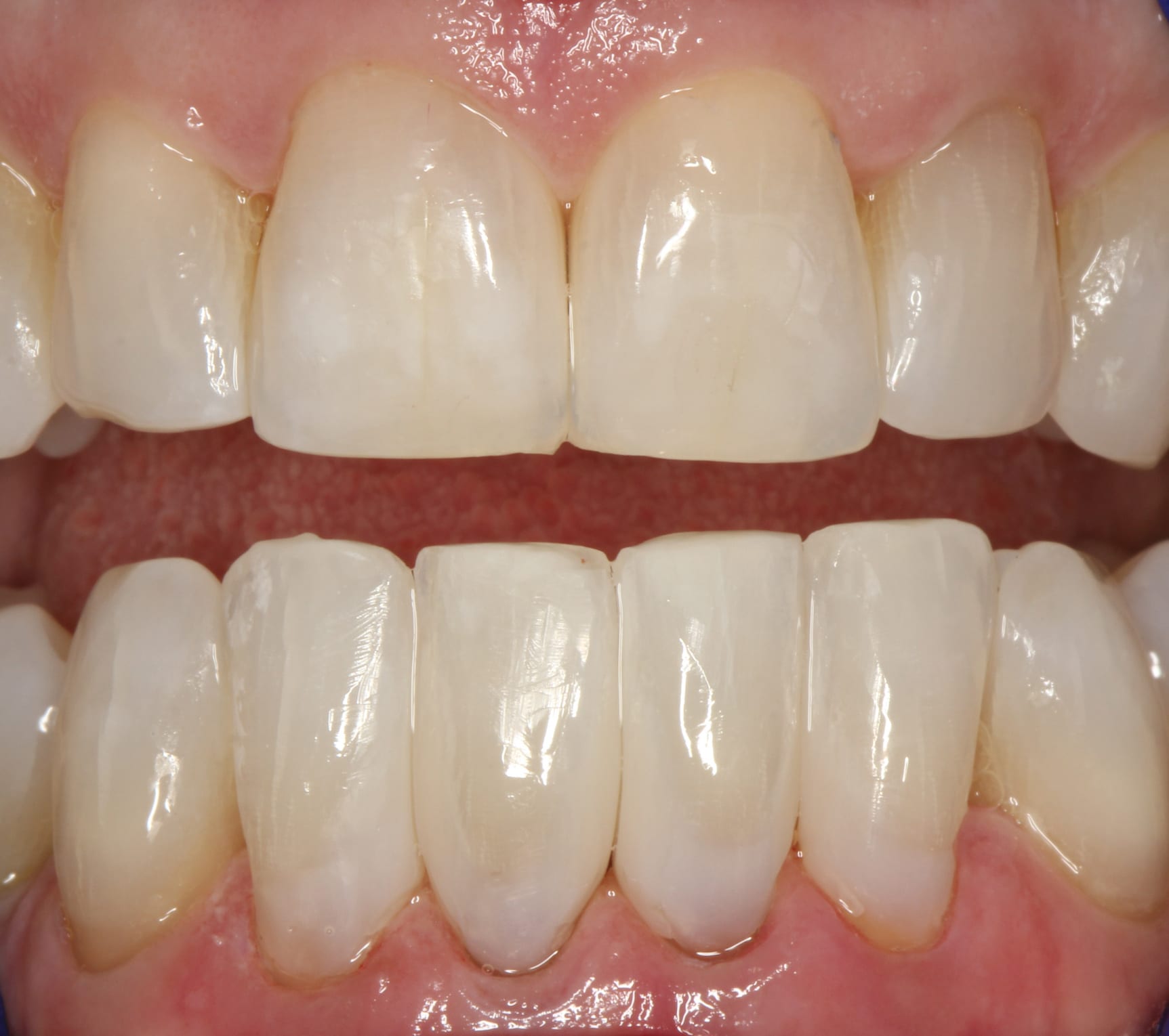 Bioclear Restorations | San Mateo Center for Cosmetic Dentistry